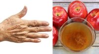 Cách siêu đơn giản loại bỏ vết đồi mồi trên da