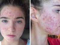Tuyệt chiêu loại bỏ mụn bọc trong 3 ngày, không thử đừng tiếc