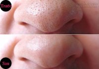 Thổi bay tận gốc mụn đầu đen chỉ sau 1 tuần nhờ 1 nắm lá húng quế
