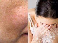 Rửa mặt với nước này mỗi ngày, nám và tàn nhang mờ dần, da trắng lên rõ rệt