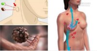 Sưng, nổi hạch trên người có phải là dấu hiệu cảnh báo ung thư?