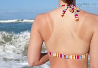 3 cách khắc phục da cháy nắng trở lại mịn màng