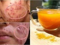 Triệt tiêu mụn trứng cá sưng tấy tận gốc mà không để lại sẹo chỉ nhờ cách này là đủ
