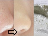 Thoa thứ này, mụn cám li ti ở cằm và cánh mũi sẽ bị hút sạch chỉ sau 30 phút.