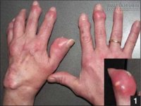 Dùng món này trong 30 ngày bệnh nhân gút biến chứng sưng to nặng cỡ nào cũng khỏi