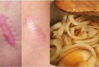Sẹo lồi lõm lâu năm đến đâu cũng sẽ bị phẳng lì nhanh chóng chỉ từ 2 công thức đơn giản này