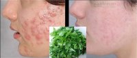 Công thức trị mụn bọc ngon lành ai làm cũng mê từ lá rau ngót