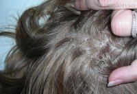 Mẹo nhỏ nhưng có võ giúp bạn cả đời không bị gàu