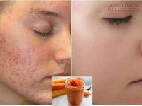 Công thức trị thâm mụn xuất sắc chỉ sau 1 tuần với cà rốt khiến bạn thích mê