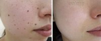 Chỉ dùng 2 loại củ này, các nốt ruồi đen trên mặt tôi biến mất hoàn toàn mà không để lại sẹo