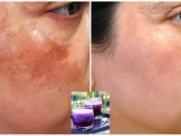 Tuyệt chiêu loại bỏ đến 90% nám trên da mặt nhờ công thức 5 ngàn đồng từ cà tím