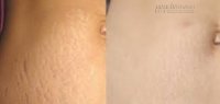 Tỏi – Thần dược là phẳng rạn da vùng bụng, hông, đùi hiệu quả 100%