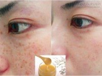 5 công thức trị nám nổi tiếng hiệu quả chỉ trong 1 tháng của người Hàn