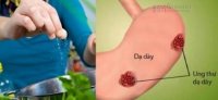 Thói quen ăn mặn tăng nguy cơ ung thư dạ dày