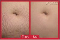 Hỗn hợp là phẳng rạn da sau sinh hiệu quả 100% – đắp 1 tuần thấy ngay kết quả