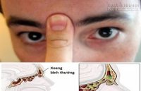Nghẹt mũi do viêm xoang hay cảm lạnh hết dứt điểm ngay sau 20 giây