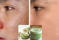Trộn đu đủ với thứ này, sẹo lõm lâu năm thế nào cũng bị xóa mờ 80%