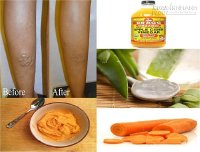 Chữa bệnh suy tĩnh mạch nặng tại nhà chỉ với vài nghìn đồng