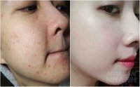 Xẹp mụn trứng cá, da láng mịn sau 1 đêm nhờ dùng thuốc nhỏ mắt có bán đầy tại các hiệu thuốc