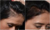Đầu hói kinh niên hay rụng tóc hàng nắm chỉ cần trộn 4 thứ này là tóc con sẽ mọc ra siêu nhanh