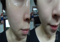 Mẹo hay diệt sạch mụn cám li ti quanh cằm 1 phát ăn ngay, tiếc gì không thử