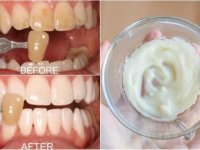 Biến răng ố vàng thành trắng sáng như bọc sứ để tự tin đón tết nếu bạn áp dụng công thức dưới đây