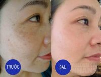 Giã nát rau mùi rồi trộn với thứ này bôi lên mặt, đốm nâu biến mất da cứ thế trắng bóc chẳng cần thoa kem