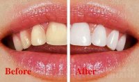 Răng xỉn bao nhiêu cũng trở nên trắng bóc nhờ ăn loại củ có sẵn rẻ tiền này
