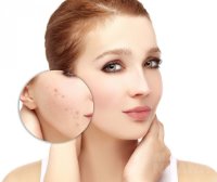 Bí quyết xóa sạch những vết sẹo mụn trên da