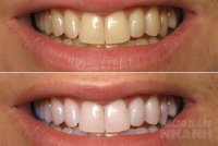 Đổ oxy già lên bông tẩy trang rồi lau, răng trắng sáng, hết ố vàng, cao răng bong thành mảng chỉ sau 1 đêm