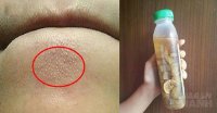 Mụn ẩn, mụn li ti cũng bay hết nhờ lọ nước tiên dược này