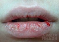 Cảnh báo: Nẻ môi, mụn má, sụp mí,… là dấu hiệu bạn đang có nguy cơ mắc hàng loạt các căn bệnh cực kì nguy hiểm đấy