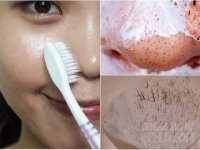 Giật mình với cách trị mụn đầu đen chi chít ở mũi chỉ bằng 1 chiếc bàn chải cũ bỏ đi