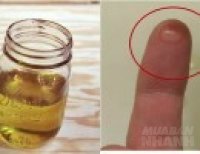 Thoa 1-2 giọt thần dược này sau 15 phút, da sạch mụn, lỗ chân lông se khít, mặt trắng bóc ai cũng làm được