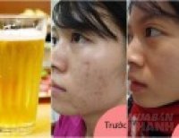 1 lon bia rẻ bèo - 3 công thức trị mụn cấp tốc mà chẳng cần bất kì một loại kem trị mụn đắt đỏ nào.