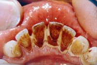 Mảng bám, ố vàng hết sạch trong tích tắc với 2 công thức chưa đến 10 ngàn đồng