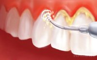 Chỉ một phút làm điều này, cao răng bong sạch và hôi miệng cũng tan theo