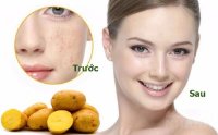 Chữa nám da đơn giản từ khoai tây và nước chanh