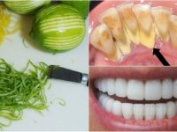 Nhai vỏ chanh trong 3 phút, cao răng, mảng bám ố vàng cứng như đá cũng tự bong ra chỉ sau 2 lần áp dụng