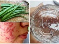 Dằm nhuyễn nha đam rồi trộn với muối – Công thức đánh bật mọi loại mụn, thâm sẹo chỉ sau vài lần thoa