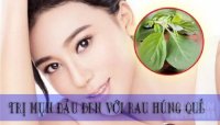 Chẳng bao giờ phải lo mụn thâm nữa nhờ cách trị mụn cực hiệu quả này