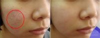 Lấp đầy sẹo rỗ lâu năm nhờ 1 vỉ vitamin E có giá vài chục nghìn, ngại gì không thử?