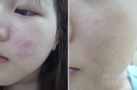 Bôi thứ nước chanh ngâm này chỉ 1 tuần mà mụn ẩn, mụn li ti bay sạch, da hồng hào thấy rõ