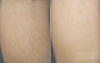 Rạn trắng, rạn đỏ trên da sẽ mờ dần mỗi ngày nhờ hỗn hợp dưới đây