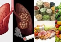 Ung thư phổi: Thực đơn và chế độ ăn uống chuẩn nhất dành cho người bị ung thư phổi
