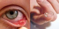 Kinh hoàng tác hại khủng khiếp khi dùng kính áp tròng giá rẻ