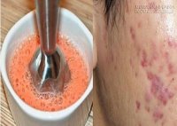 Thâm – Sẹo Lâu Năm Cỡ Nào, Đắp Hỗn Hợp Này Cũng Khỏi