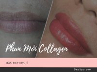Phun môi collagen là gì?