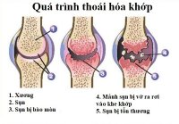 Người bị thoái hóa xương khớp nên ăn gì, kiêng gì