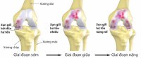 Tại sao nói thoái hóa khớp gối ở phụ nữ cao hơn đàn ông?